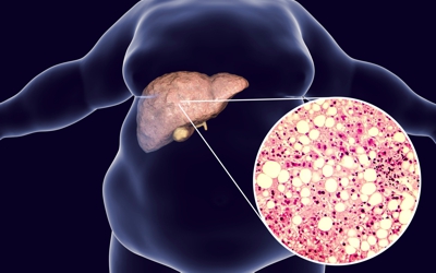 Ep #112 Nonalcoholic Fatty Liver Disease (NAFLD)
